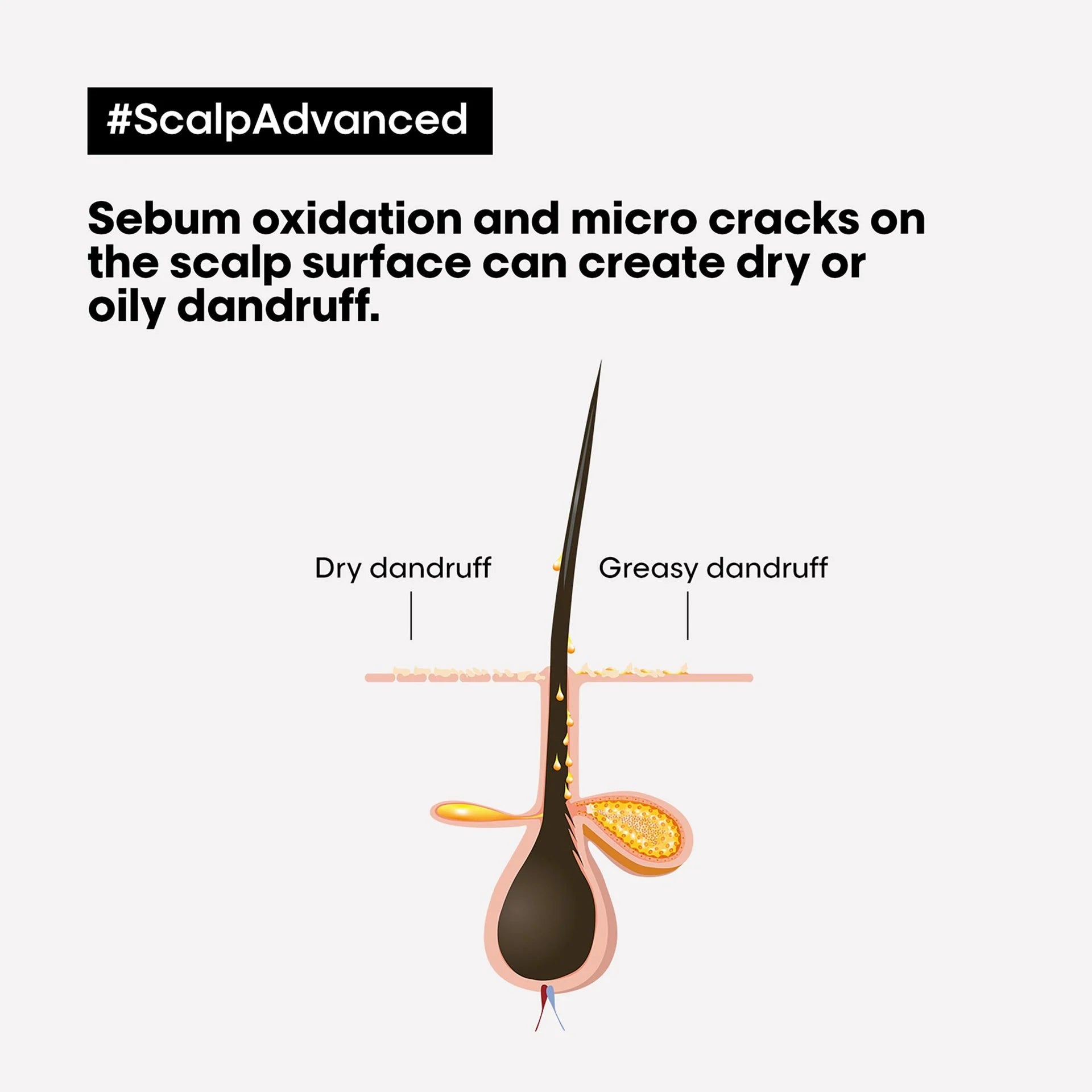 L'Oréal Professionnel Scalp Advanced Anti-Discomfort Shampoo 300 ml