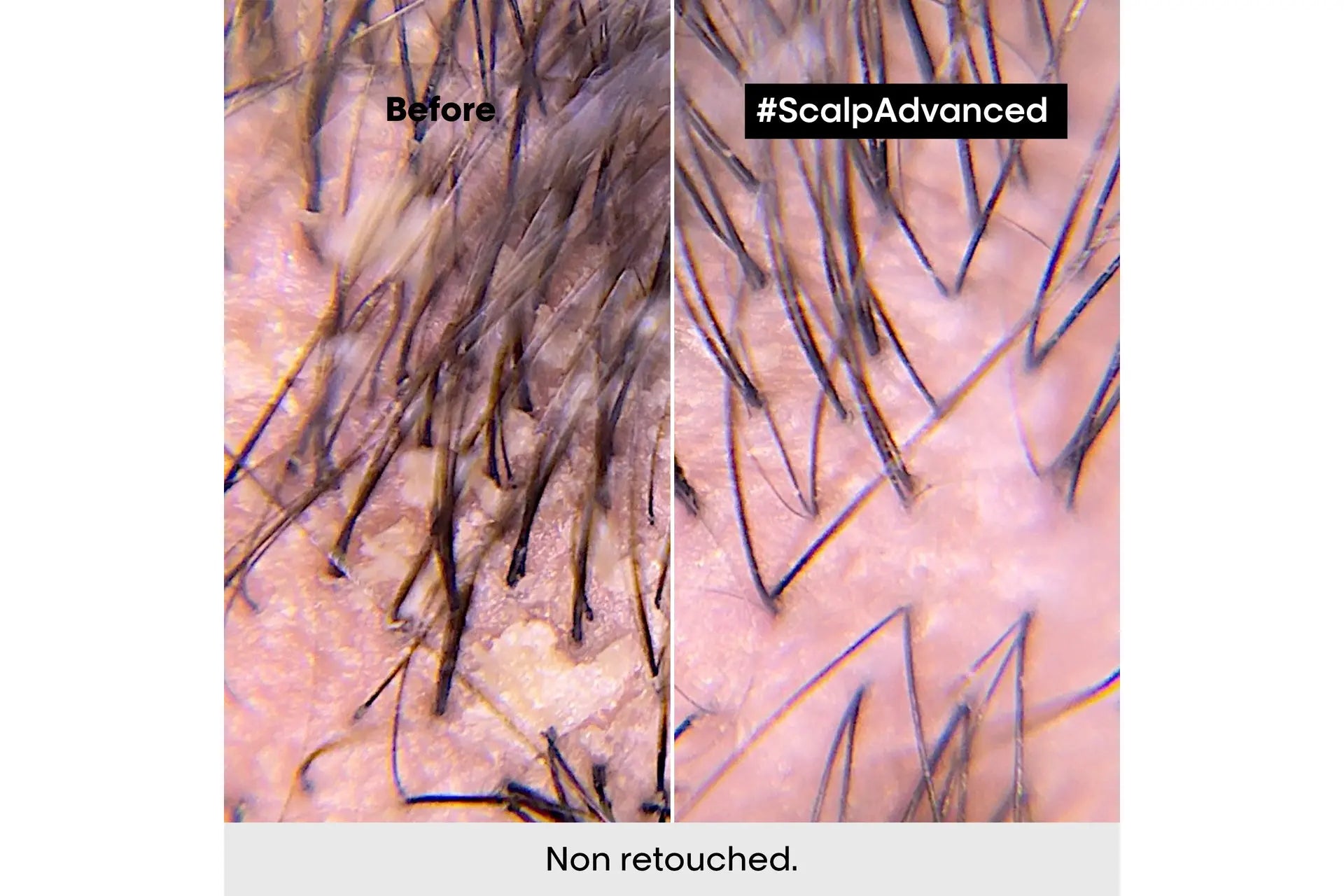 L'Oréal Professionnel Scalp Advanced Dandruff Shampoo 300 ml