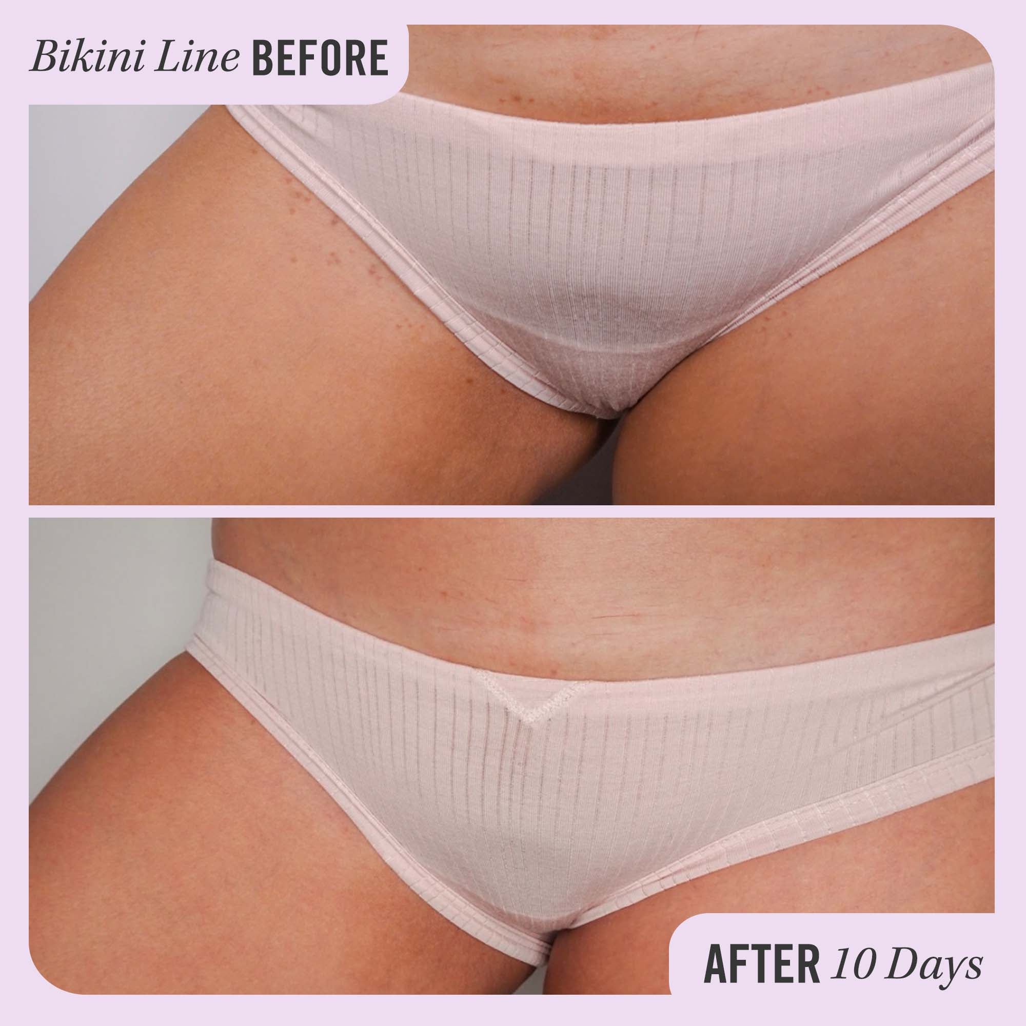 First Aid Beauty Ingrown Hair Pads with BHA & AHA 60 Discos