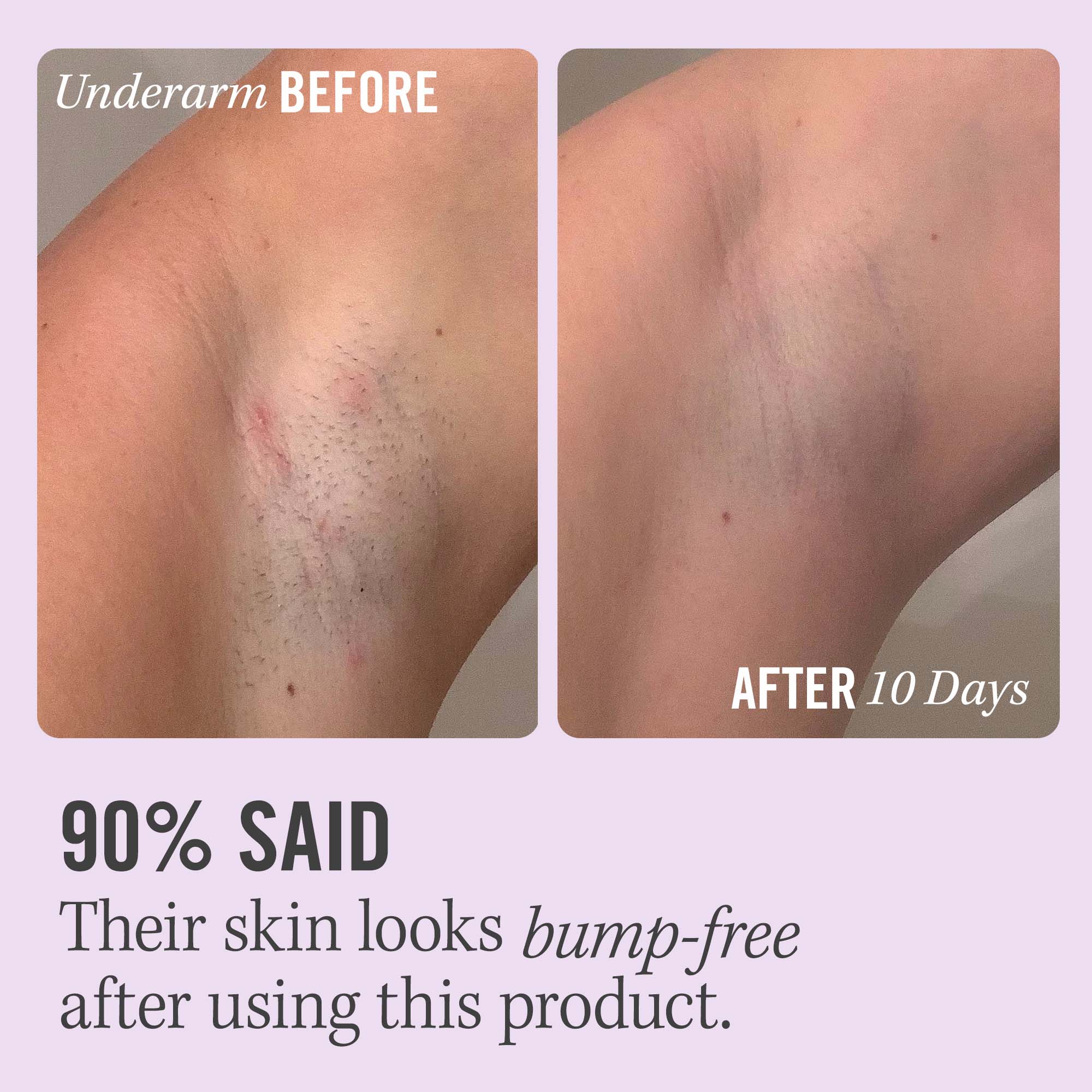 First Aid Beauty Ingrown Hair Pads with BHA & AHA 60 Discos